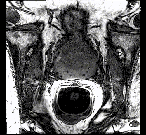 Sirius MRI Marker