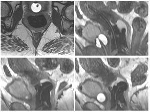 Orion HDR Brachytherapy