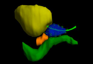 3D rendering of prostate